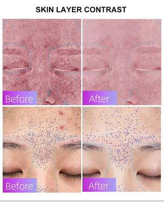 comprare Blue Light Acne Treatment Mask with Intelligent Timer – Manufacturer Direct Supply, Appearance Patent Included fabbricazione online